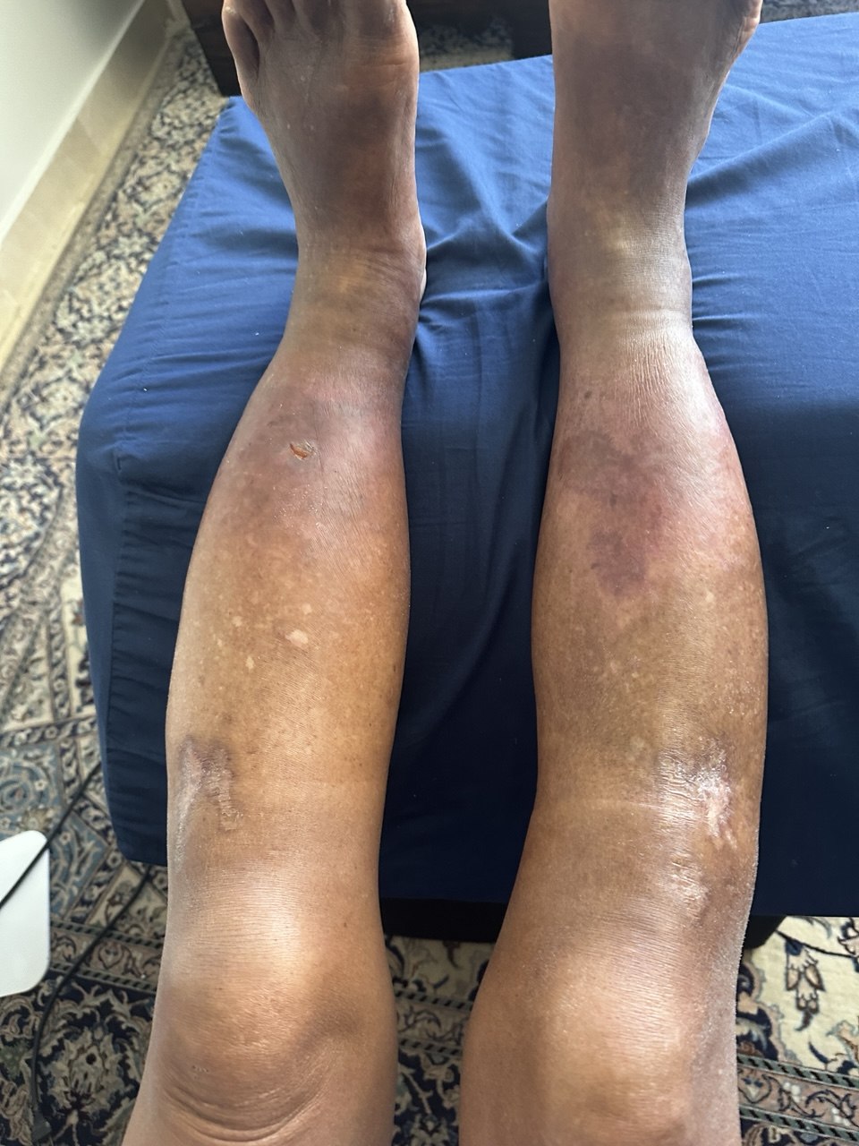 Both legs fully healed, the wound closed to a faint scar - no surgery, no amputation
